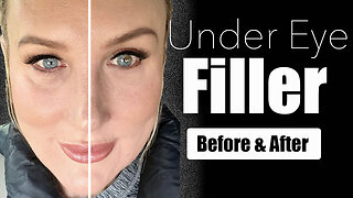 Under Eye Filler Before & After // Watch this BEFORE You Dissolve Filler!!!