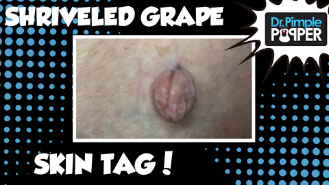 A Shriveled Grape Skin Tag on Inner Thigh