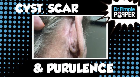 WAIT FOR IT!! Multiloculated Cyst, Scar and Squeeze