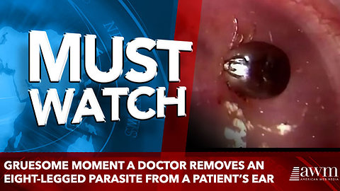 Gruesome moment a doctor removes an eight-legged parasite from a patient’s ear