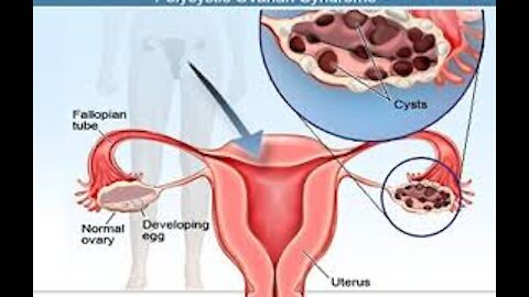 HOW TO GET RID OF OVARIAN CYSTS