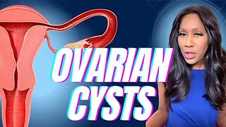 What Are Ovarian Cysts? What Are the Symptoms? How Are Ovarian Cysts Treated? A Doctor Explains