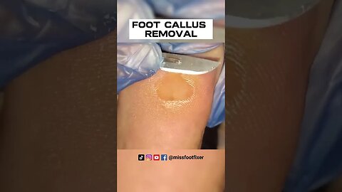 FOOT CALLUS REMOVAL 2022 (PAINLESS PROCEDURE) | SATISFYING CALLOUS TREATMENT BY MISS FOOT FIXER