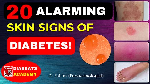 20 ALARMING SKIN SIGNS AND SYMPTOMS OF DIABETES WITH CLEAR PICTURES!