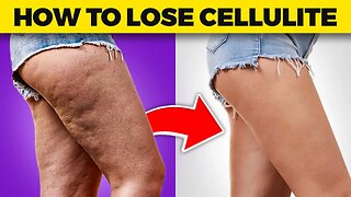 Cellulite Be Gone: Dr. Berg's Expert Tips on Losing Thigh and Buttock Cellulite