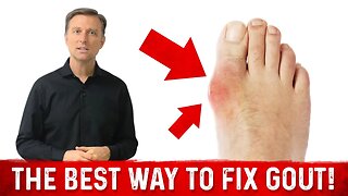 GOUT ARTHRITIS: What Causes Gout and What Foods to Avoid for Gout