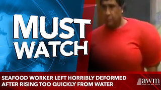Seafood worker left horribly deformed after rising too quickly from water