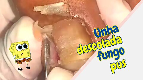 UNHA em TELHA com FUNGO e PUS #unhas #pes #dor #podologia #fungos #procedimento