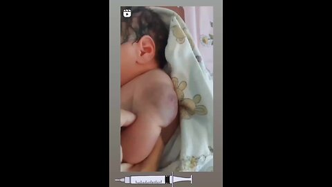 Bebé vacunado con brazo dañado