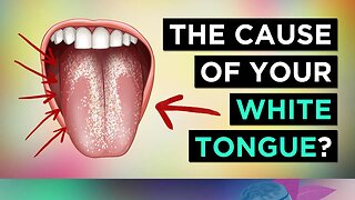 Do You Have A White Tongue (Cause & Treatment)