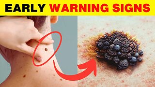 Visit Doctor Right Now if You Have These 12 Early Warning Signs of Cancer | Natural Cures