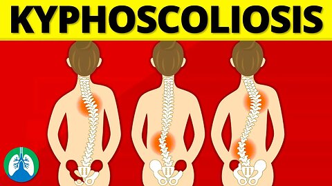 Kyphoscoliosis (Medical Definition) | Quick Explainer Video