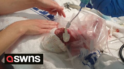 Premature baby was so tiny doctors put her into a SANDWICH BAG to mimic her mother's womb