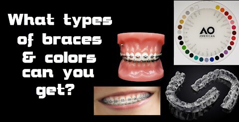 What types of braces & colors can you get?