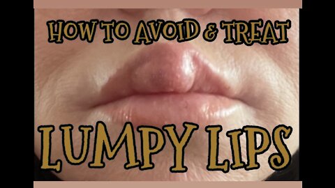 A Case Study in Lumpy Lips