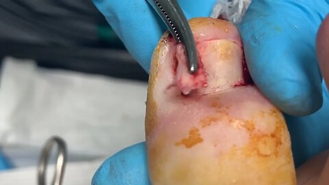 Unha encravada? Não sofra mais! Assista a esse passo a passo de remoção #podiatrist #ingrown_toenail