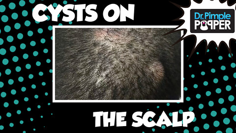 How many Cyst-ers are on this Scalp?!