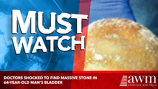 Doctors shocked to find massive stone in 64-year-old man’s bladder