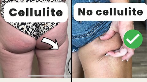 How to get rid of cellulite (it’s so easy)!