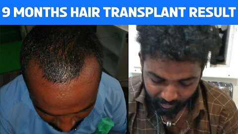 9 Months Hair Transplant Result