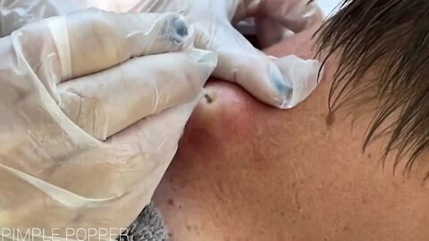 2 Satisfying Explosive Pimple Popping Videos