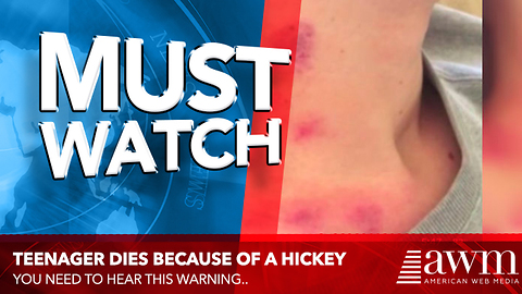Her Teen Died Because Of A Hickey, Doctors Warn It’s More Common Than You Think