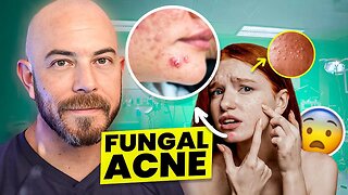 How to Get Clear Skin if You Have Fungal Acne - Dermatologist Explains