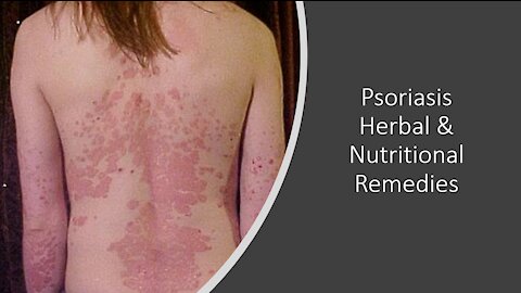 Psoriasis - Supplements, Herbs & Vitamins