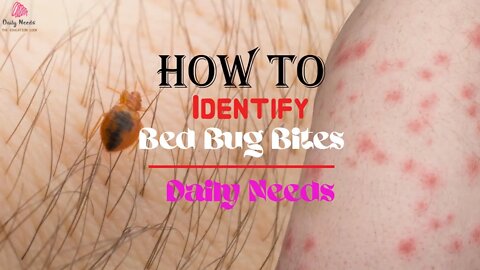 How to Identify Bed Bug Bites | 9 Steps to Identify Bed Bug Bites - Daily Needs Studio