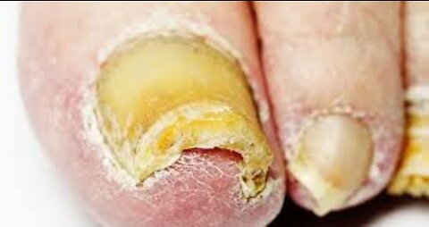 Effective HOME REMEDIES To CURE Toenail FUNGUS
