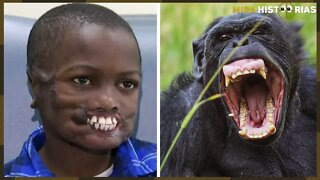 Lembra do congolês desfigurado por chimpanzés? Ele se recuperou do trauma e se tornou um campeão