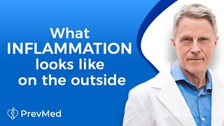 What Inflammation Looks Like on the Outside