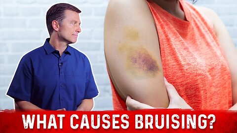 What Causes Bruising (Without Trauma) – Dr. Berg
