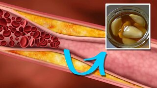 How to Lower Triglycerides Quickly and Naturally