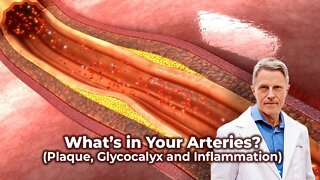 What’s in Your Arteries? (Plaque, Glycocalyx & Inflammation)