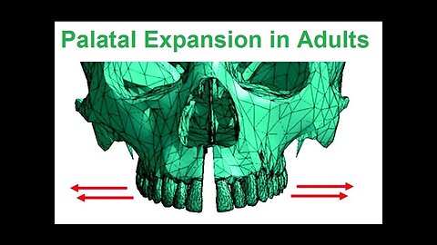 Is Palatal Expansion Possible In Adults By Dr Mike Mew