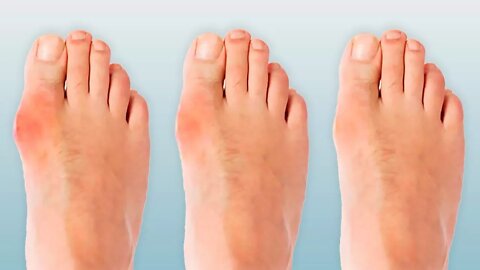 4 Ways to Ease Your Bunions Without Surgery