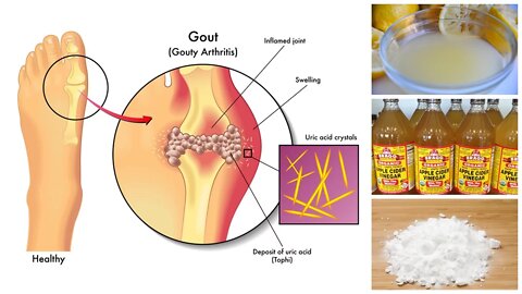 How to Lower Uric Acid Naturally