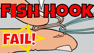 Removing a Fish Hook - The easy way! (hook in my side!)