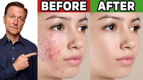 The Secret to Clear Skin: Fight Acne, Slow Wrinkles, and Eliminate Liver Spots