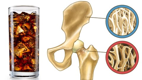5 Ways That Sugary Soda is Bad For Your Health