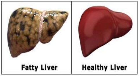 The Ultimate Fatty Liver Detox