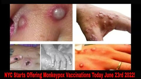 NYC Starts Offering Monkeypox Vaccines Today June 23rd 2022!