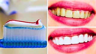 5 Tips for Whiter Teeth: How to Get a Brighter Smile