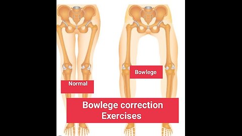 Bow leges correction Exercises