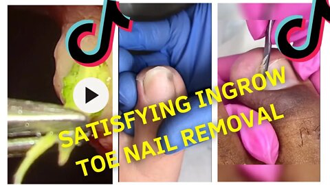 Ingrown Toe Nail Removal Compilation #1 #ingrowntoenail #ingrownnail #ingrown #ingrowntoenailremoval