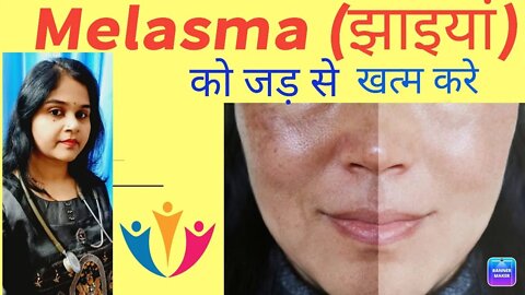 Melasma (झाइयां) को जड़ से खत्म करे। #melasma #झाइयां,#homeopathy #melasmacream #melasmatreatment