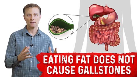 Does Eating Fat Cause Gallstones? – Dr. Berg