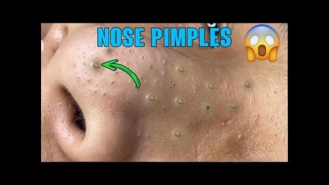 Amazing Nose BlackHeads | Very Satisfying Video | Watch Complete