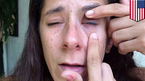 Super glue in eye: Florida woman nearly blinded after accidentally gluing her eye shut - TomoNews